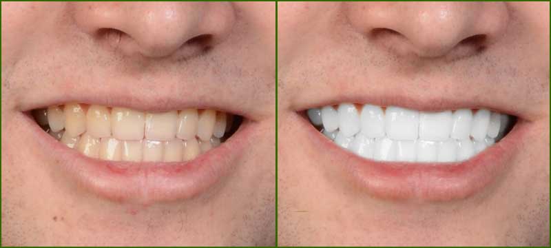 Teeth Whitening